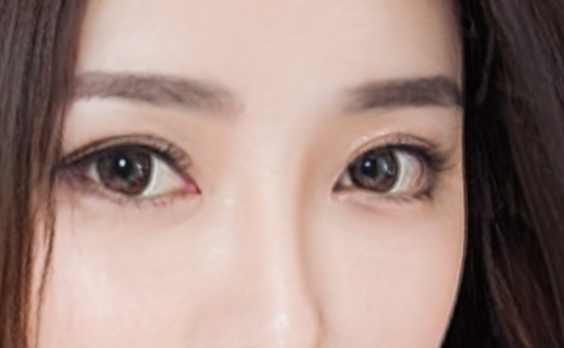 双眼皮术后痒是增生吗？