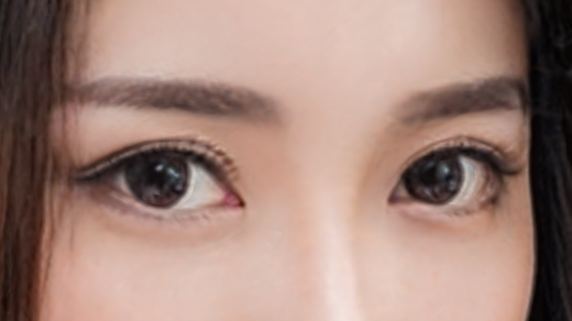 双眼皮埋线需要几天恢复？