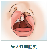 唇腭裂是什么原因造成的?唇腭裂究竟是怎样一种疾病?